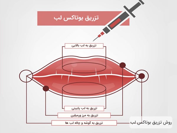 چه کسانی باید بوتاکس لب انجام دهند؟