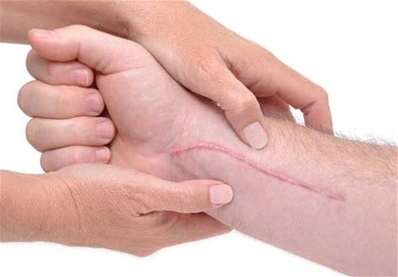 اسکار چیه و چرا انقدر مهمه که درمانش کنیم؟